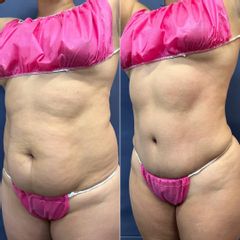 Abdominoplastía