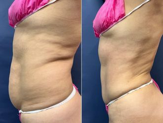 Abdominoplastia antes y después - 879104
