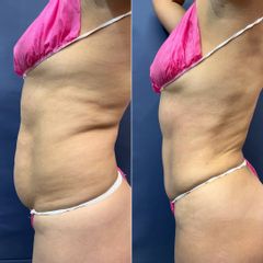 Abdominoplastía