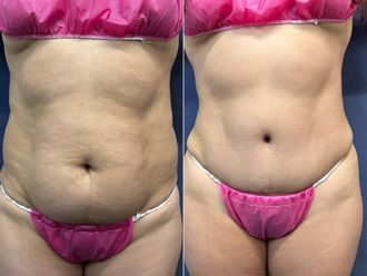 Abdominoplastia antes y después - 879105