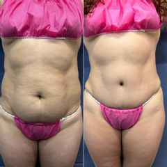 Abdominoplastía