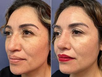 Rinoplastia antes y después - 879287