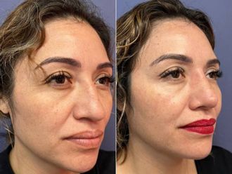 Rinoplastia antes y después - 879288