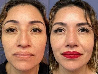 Rinoplastia antes y después - 879289