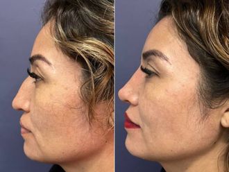 Rinoplastia antes y después - 879290