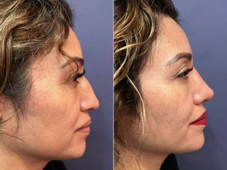 Rinoplastia antes y después - 879360