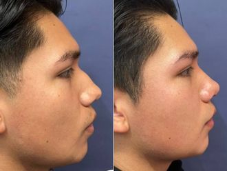 Rinoplastia antes y después - 879361