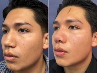 Rinoplastia antes y después - 879362