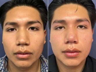 Rinoplastia antes y después - 879363