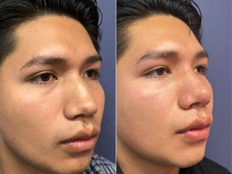 Rinoplastia antes y después - 879364
