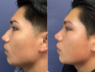 Rinoplastia antes y después - 879365