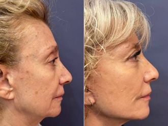 Rinoplastia antes y después - 879366