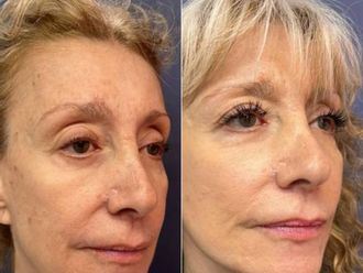 Rejuvenecimiento facial antes y después - 879367