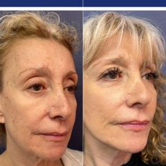 Rejuvenecimmiento facial
