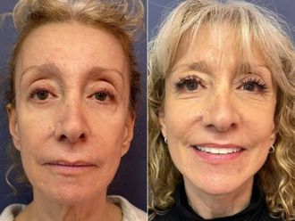 Rejuvenecimiento facial antes y después - 879368