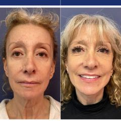 Rejuvenecimmiento facial