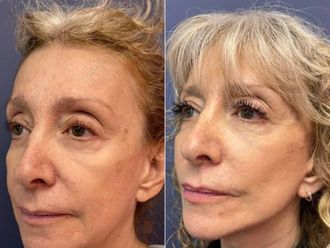 Rejuvenecimiento facial antes y después - 879369