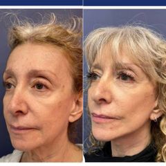 Rejuvenecimmiento facial