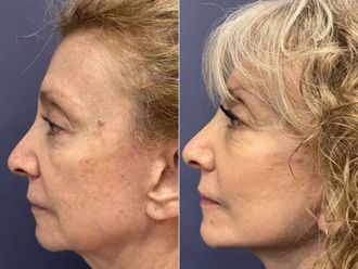 Rejuvenecimiento facial antes y después - 879370