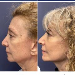 Rejuvenecimmiento facial
