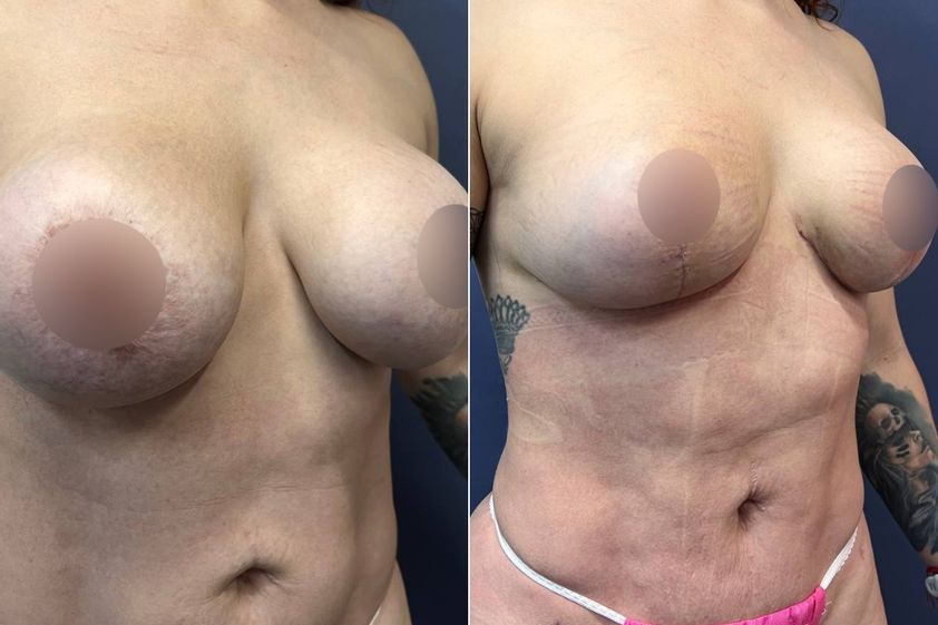 Mastopexia antes y después - 879382