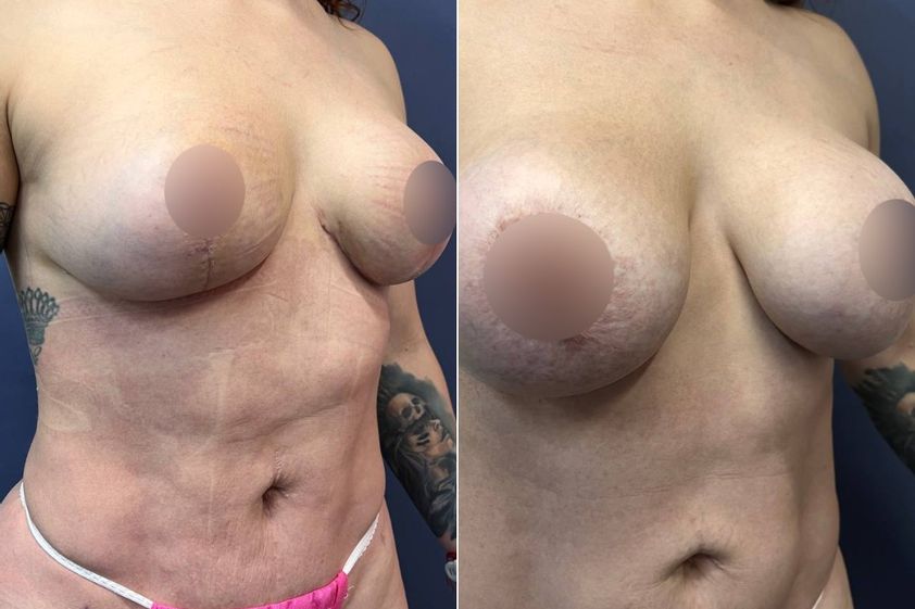 Mastopexia antes y después - 879384