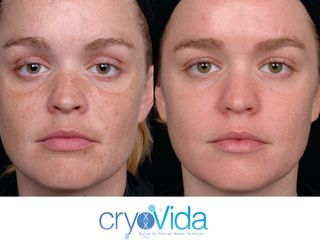 Antes y después de tratamiento de limpieza facial