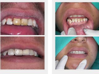 Antes y después de Blanqueamiento dental 