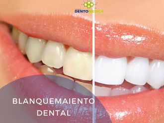 Blanqueamiento Dental - 605610