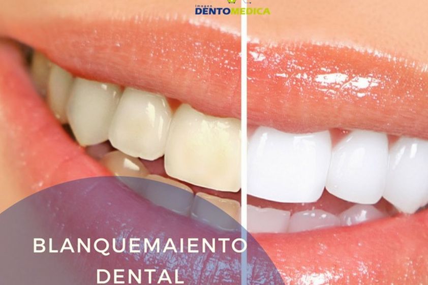 Blanqueamiento Dental antes y después - 605610