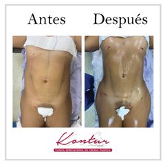 Antes y después de Lipoescultura