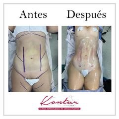 Antes y después de Lipoescultura