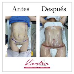 Antes y después de Abdominoplastia