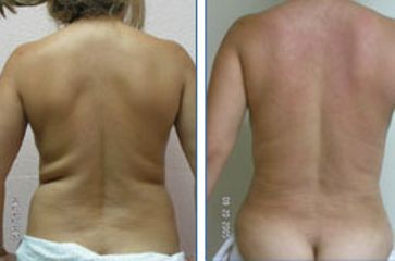 Antes y después de Liposucción