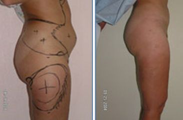 Antes y después de Liposucción