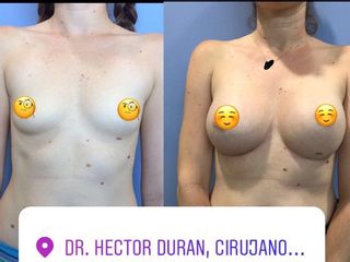 Antes y después de Aumento de busto
