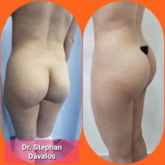 Antes y después de Gluteoplastia - Dr. Stephan Dávalos