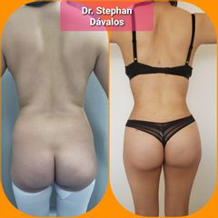 Gluteoplastia - Dr. Stephan Dávalos