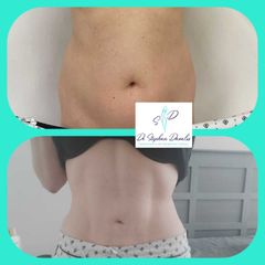 Liposucción - Dr. Stephan Dávalos