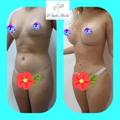 Lipoescultura - Dr. Stephan Dávalos