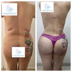 Gluteoplastia - Dr. Stephan Dávalos