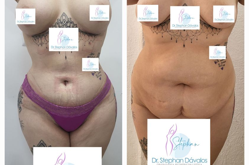 Mommy makeover antes y después - 850878