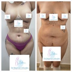 Mommy makeover - Dr. Stephan Dávalos