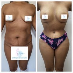 Mommy makeover - Dr. Stephan Dávalos