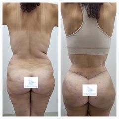 Abdominoplastia - Dr. Stephan Dávalos