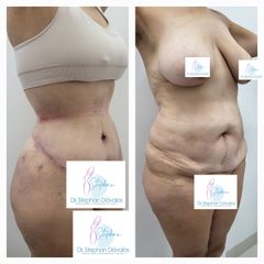 Abdominoplastia - Dr. Stephan Dávalos