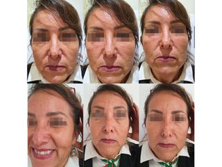 Antes y después de toxina botulínica