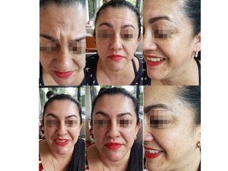 Antes y después de toxina botulínica