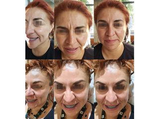 Antes y después de toxina botulínica