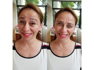 Antes y después de toxina botulínica